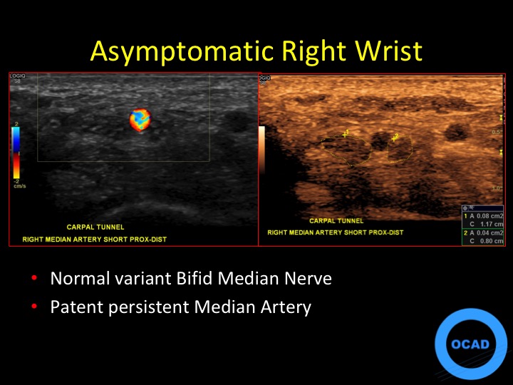 Figure 5 for case thrombus ( RID5037 )